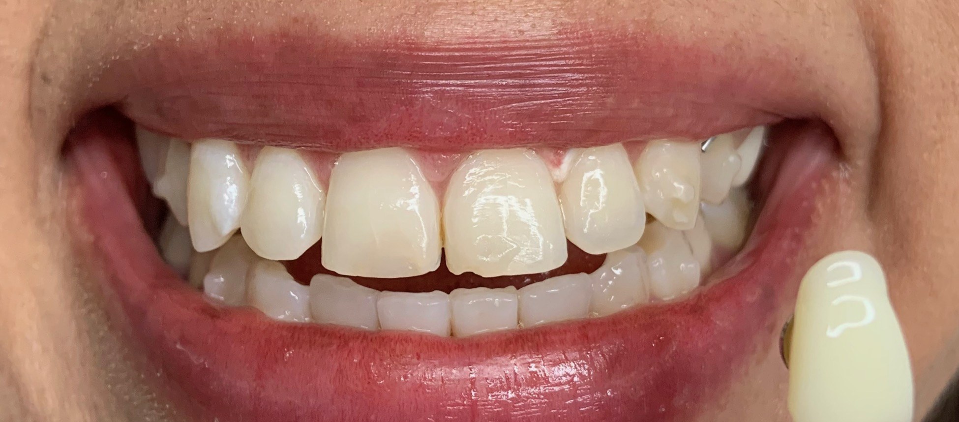 The same guest's smile after their Bright Now whitening visit