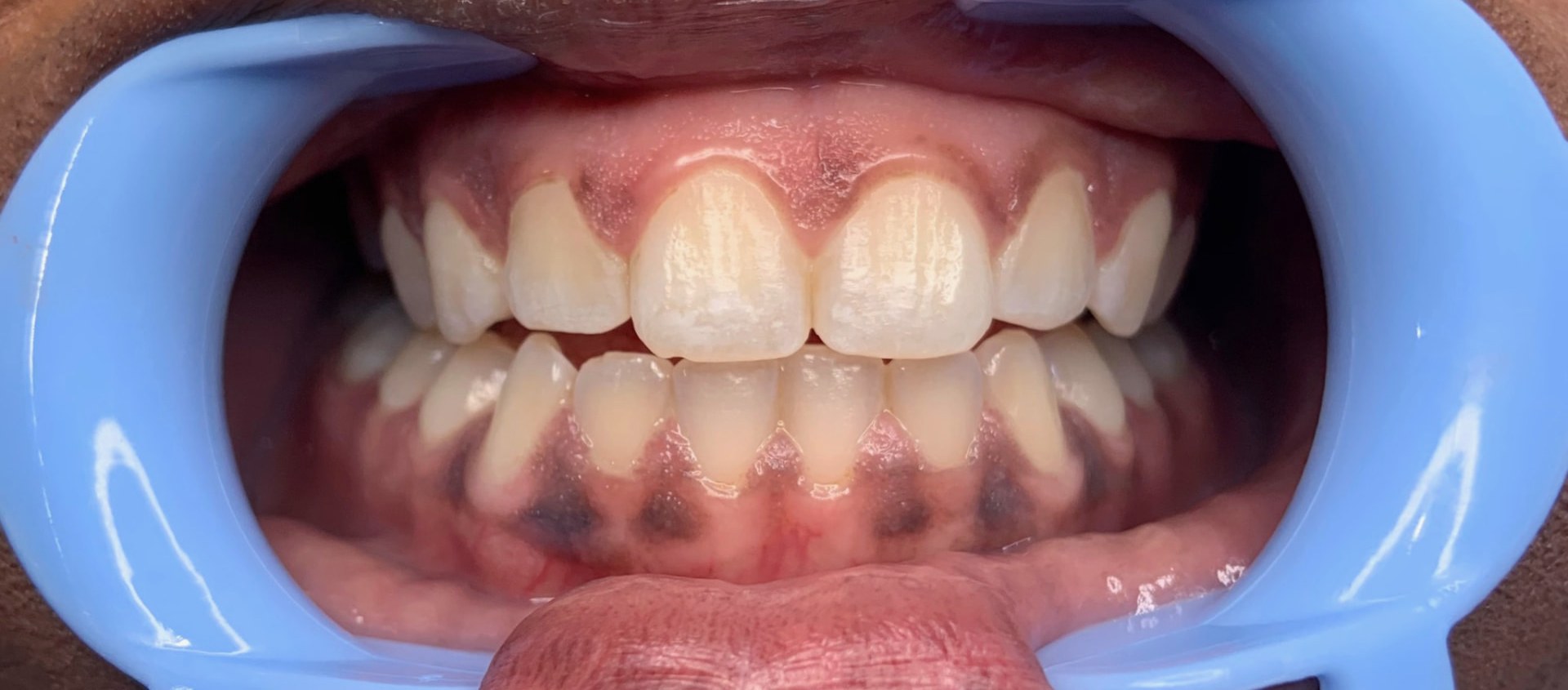 Guest's teeth beside a shade guide tab before whitening