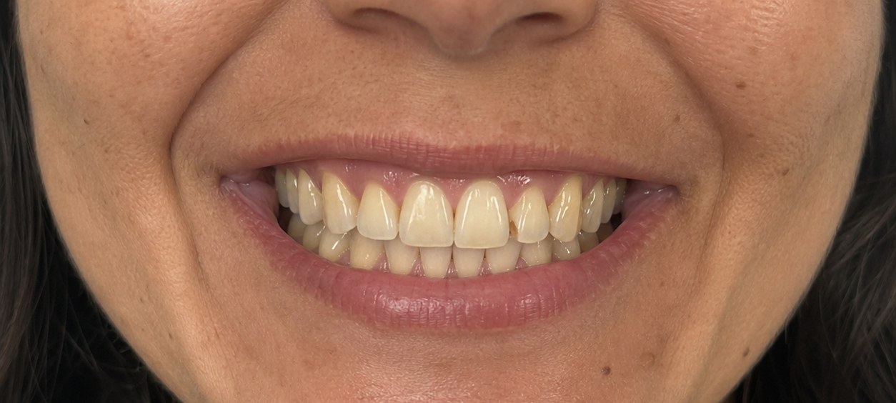 Close-up of a guest's teeth before their Bright Now whitening visit