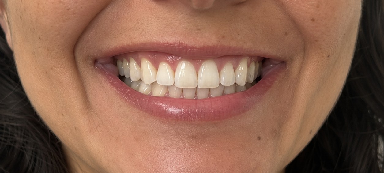 Close-up of the same guest's teeth after their Bright Now whitening visit