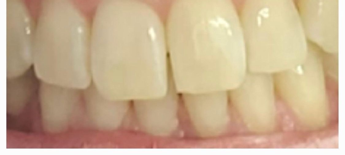 Guest's upper front teeth before their Bright Now whitening visit