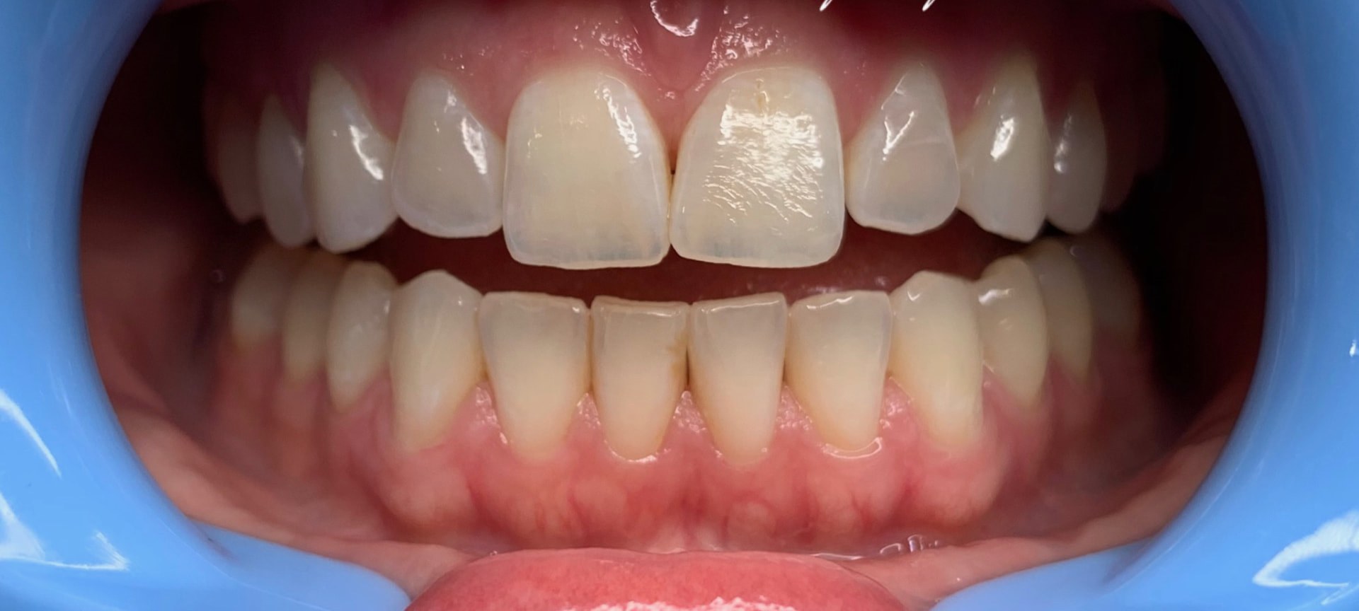 Guest's teeth compared with a shade guide tab before whitening