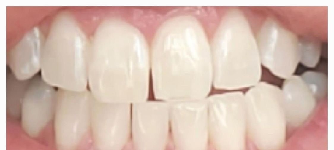 The same guest's upper front teeth after their Bright Now whitening visit