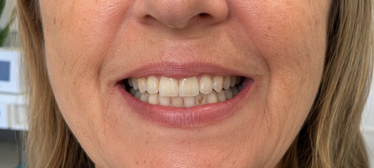 Guest's smile photographed before their Bright Now whitening visit