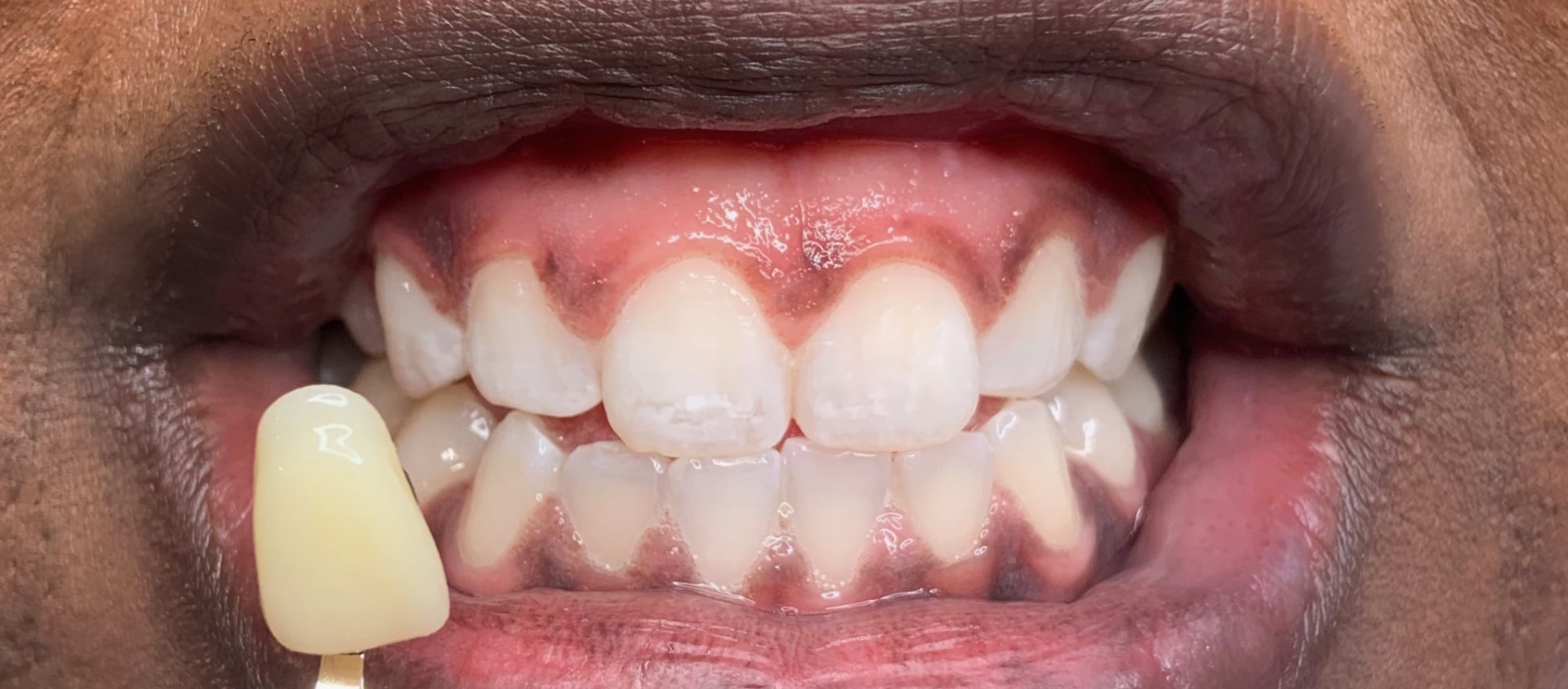The same guest's teeth beside a shade guide tab after whitening