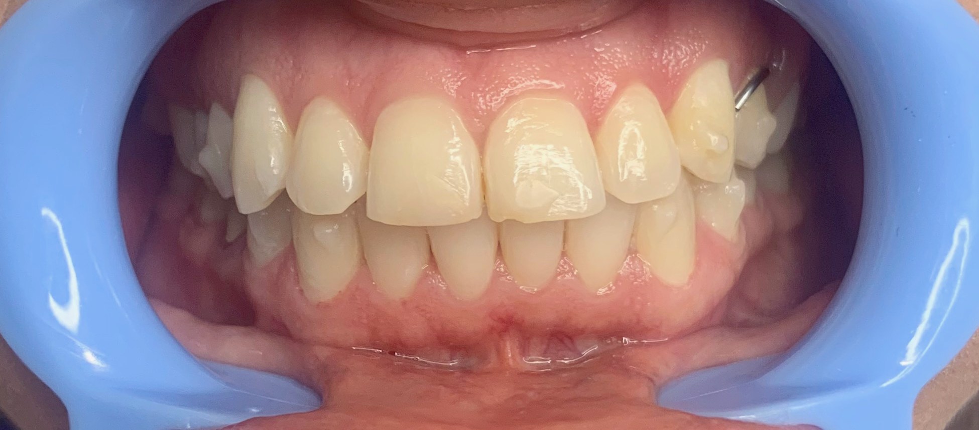 Guest's smile before their Bright Now whitening visit