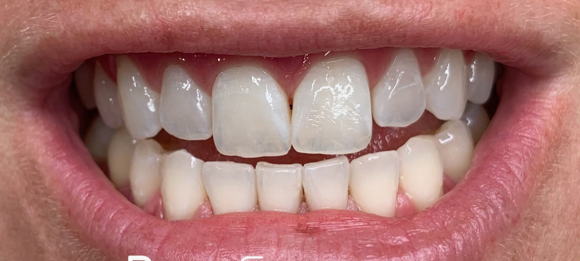 The same guest's teeth compared with a shade guide tab after whitening